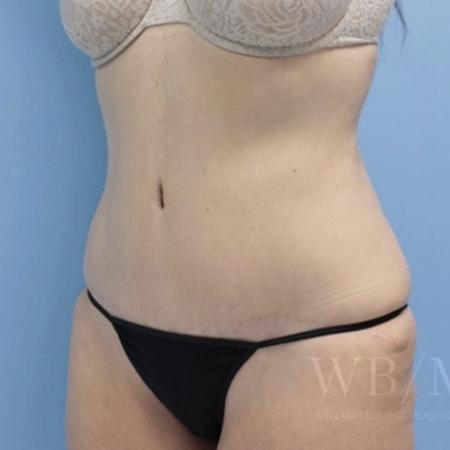 After image 2 Case #134106 - Tummy Tuck