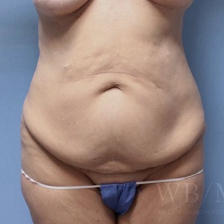 Before image 1 Case #134106 - Tummy Tuck