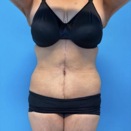 After image 1 Case #134021 - Body Lift