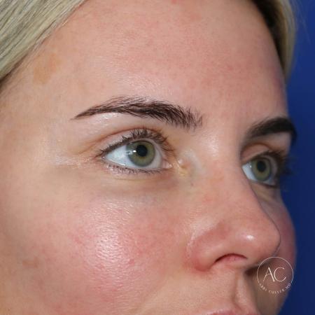 After image 3 Case #133666 - Upper blepharoplasty