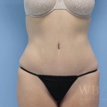 After image 1 Case #134106 - Tummy Tuck