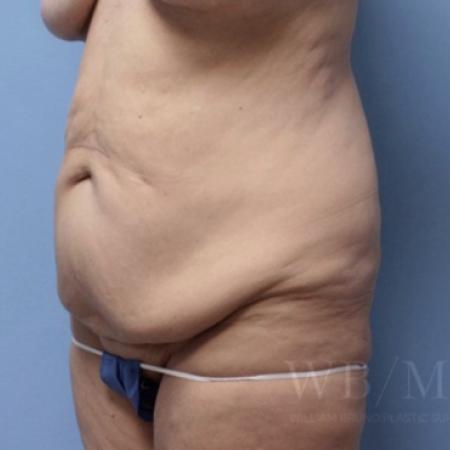 Before image 2 Case #134106 - Tummy Tuck
