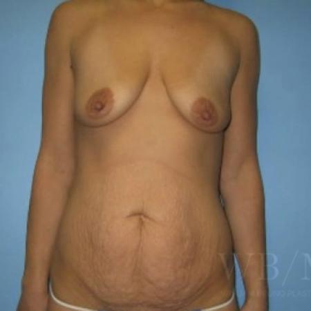 Before image 1 Case #134101 - Mommy Makeover
