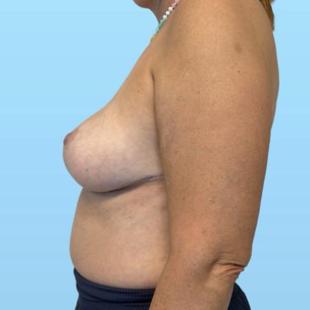 After image 2 Case #134026 - Breast Reduction