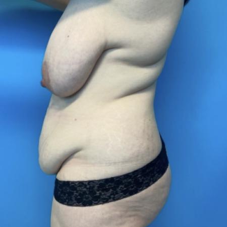 Before image 2 Case #134001 - Mommy Makeover
