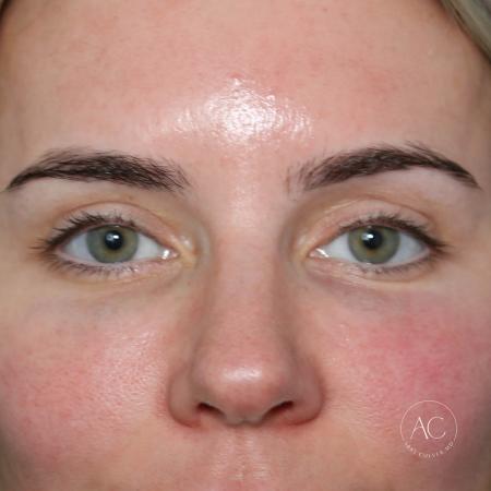 After image 1 Case #133666 - Upper blepharoplasty
