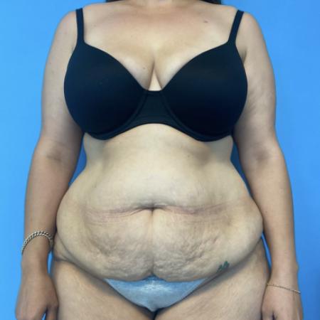 Before image 1 Case #134011 - Tummy Tuck