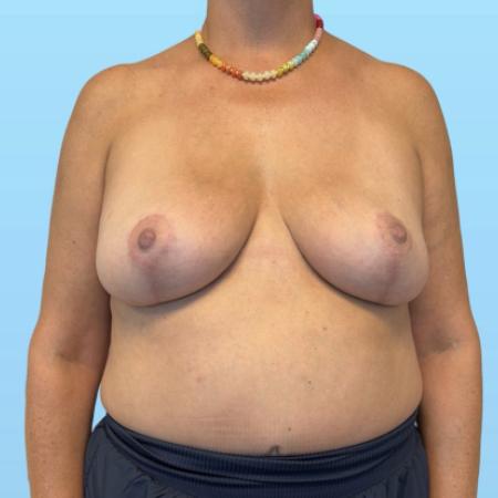 After image 1 Case #134026 - Breast Reduction