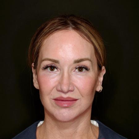 After image 1 Case #133616 - Deep Plane Face Lift