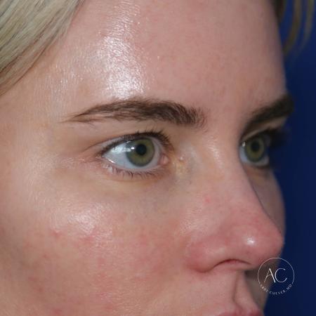 Before image 3 Case #133666 - Upper blepharoplasty