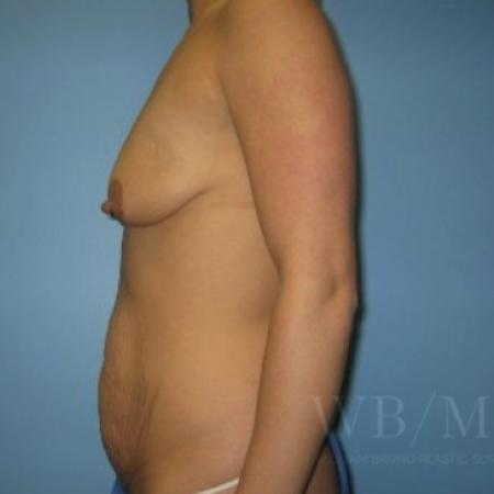 Before image 3 Case #134101 - Mommy Makeover