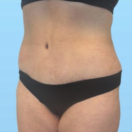 After image 2 Case #133996 - Tummy tuck