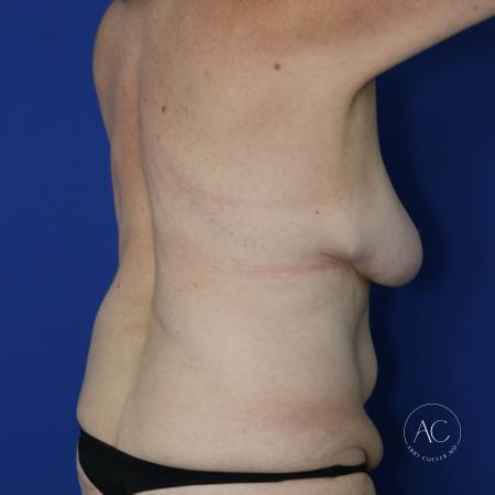 Before image 4 Case #134096 - Extended abdominoplasty