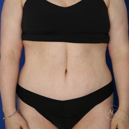 After image 1 Case #133751 - Extended abdominoplasty with liposuction 