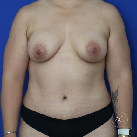 After image 1 Case #134636 - Breast augmentation with lipoabdominoplasty