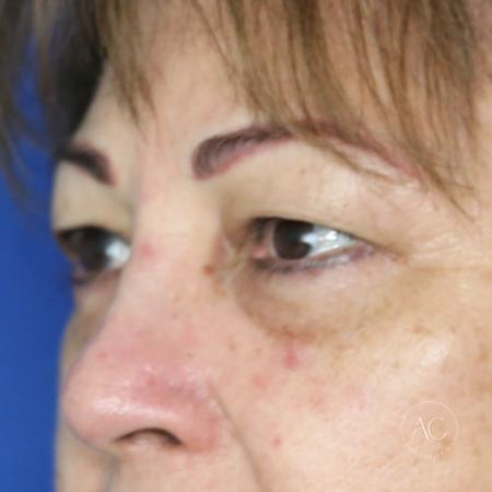 Before image 2 Case #134661 - Upper blepharoplasty