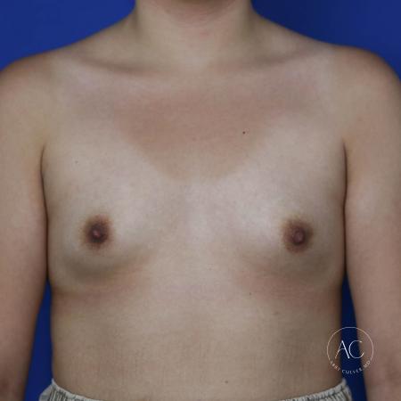 Before image 1 Case #134621 - Breast augmentation