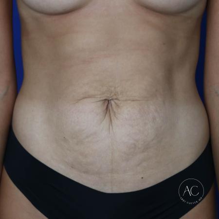 Before image 1 Case #134656 - Abdominoplasty with liposuction