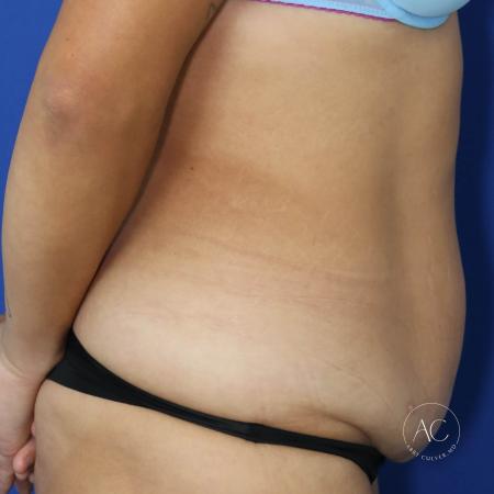 Before image 3 Case #134666 - Extended abdominoplasty with liposuction