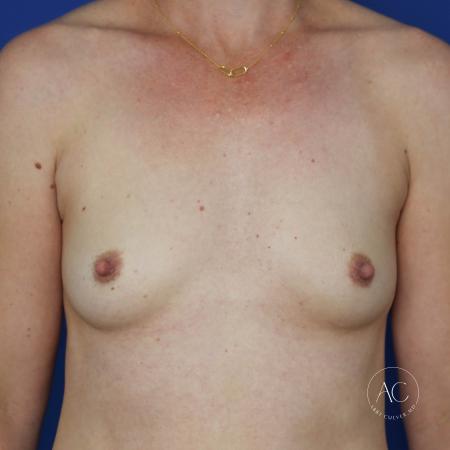 Before image 1 Case #134651 - Breast augmentation