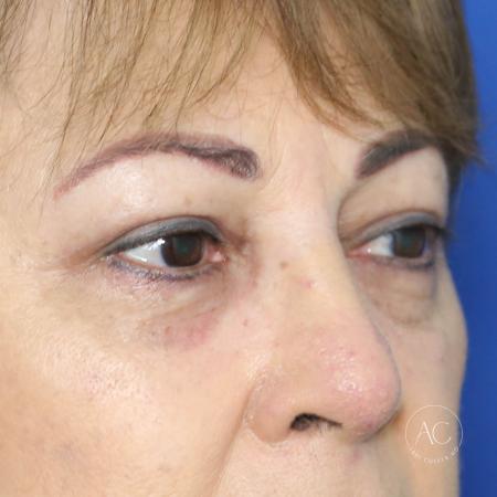 After image 3 Case #134661 - Upper blepharoplasty