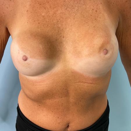 After image 1 Case #134821 - 72 y.o. female with breast augmentation 