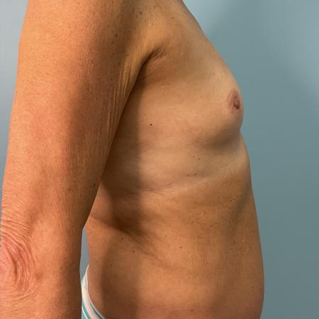 Before image 3 Case #134821 - 72 y.o. female with breast augmentation 