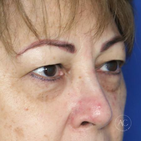 Before image 3 Case #134661 - Upper blepharoplasty