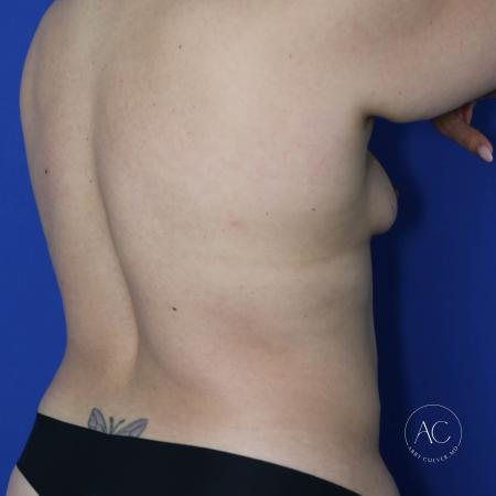 Before image 4 Case #134636 - Breast augmentation with lipoabdominoplasty