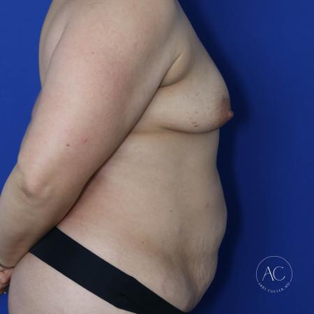 Before image 3 Case #134636 - Breast augmentation with lipoabdominoplasty