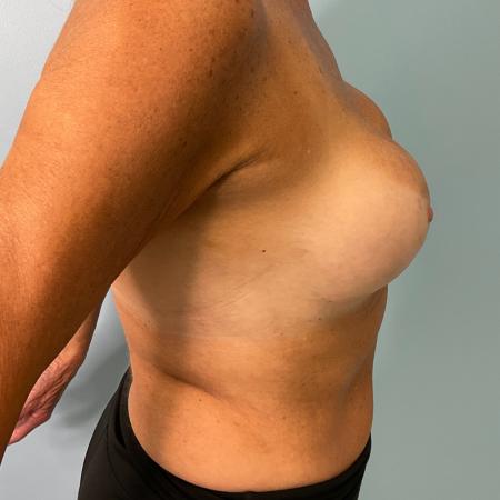 After image 3 Case #134821 - 72 y.o. female with breast augmentation 