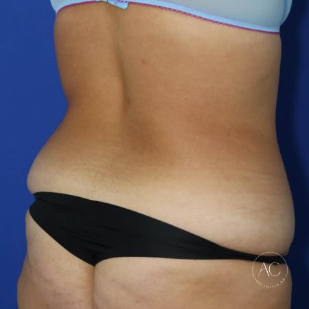 Before image 4 Case #134666 - Extended abdominoplasty with liposuction