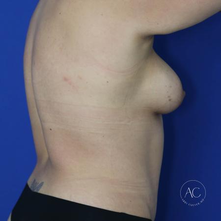 After image 4 Case #134636 - Breast augmentation with lipoabdominoplasty