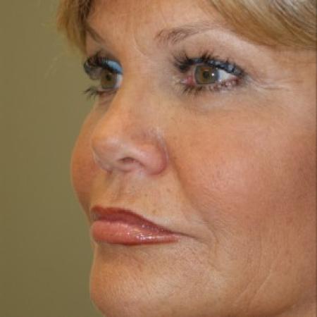 Before image 2 Case #81906 - Facelift