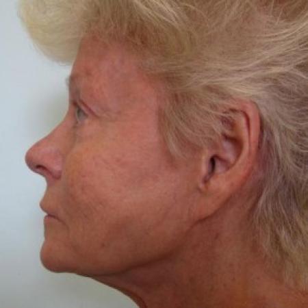 Before image 2 Case #82701 - 71 Year Old Women's Facial Rejuvenation