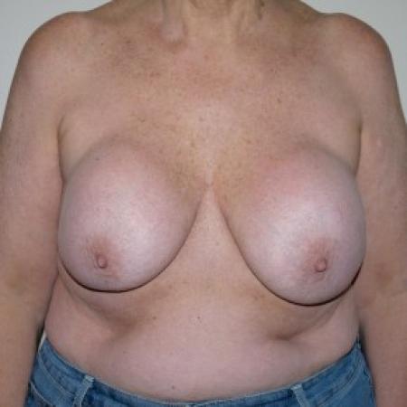 Before image 1 Case #82361 - Augmentation Mastopexy