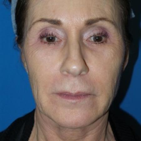 Before image 1 Case #86576 - Facelift/Laser Resurfacing to Full Face     1 month post-op