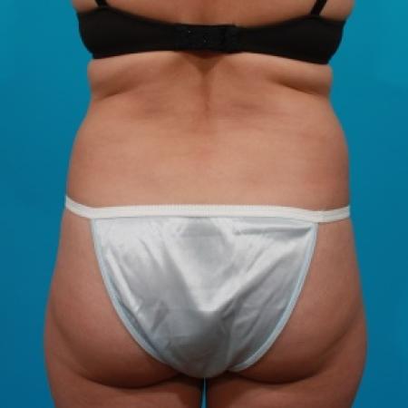 Before image 5 Case #80771 - Tummy Tuck & Flank Liposuction