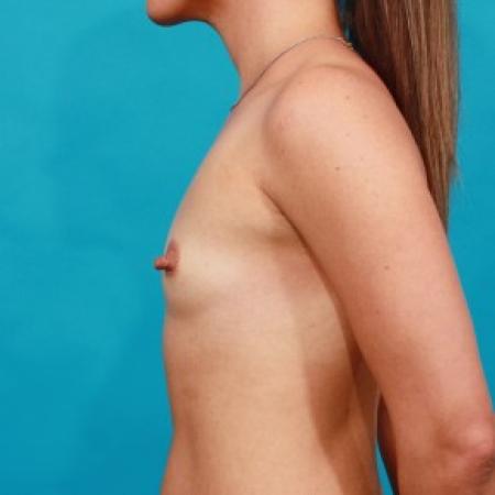 Before image 3 Case #85761 - Shaped Breast Augmentation