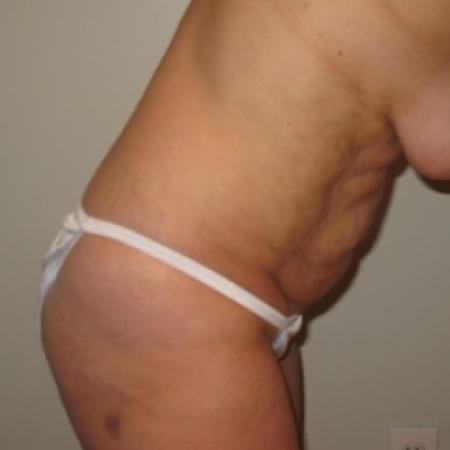 Before image 2 Case #79921 - Tummy Tuck 