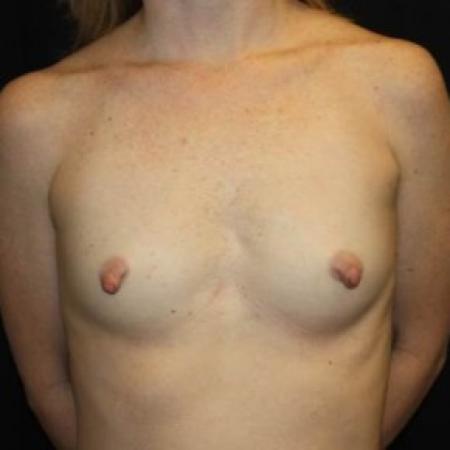 Before image 1 Case #84881 - Breast Augmentation - 40 year old female