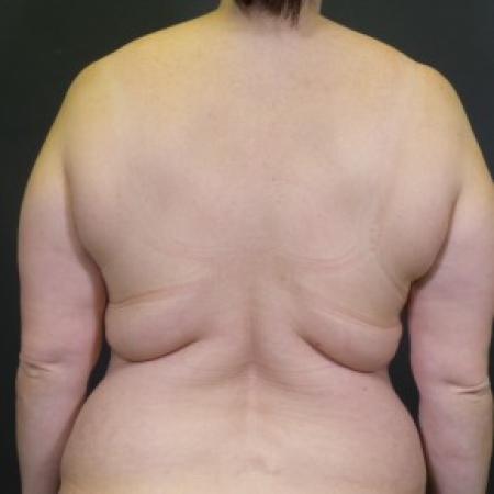 Before image 2 Case #84566 - Backlift