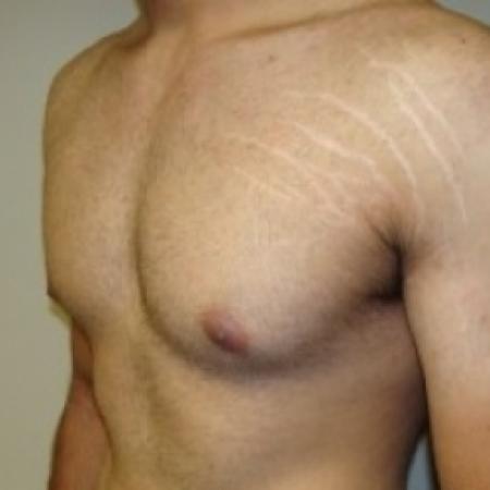 Before image 2 Case #79046 - Gynecomastia