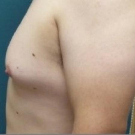 Before image 2 Case #86676 - Gynecomastia Correction