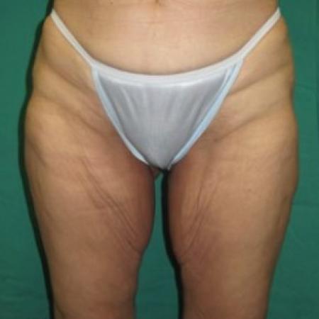 Before Case #85671 - Thigh Lift 
