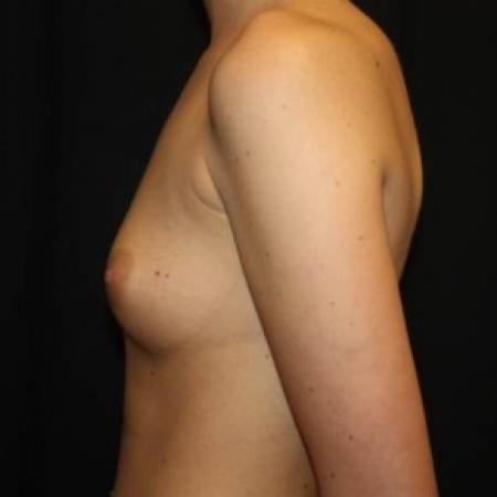 Before image 3 Case #85041 - Breast Augmentation - 23 year old female