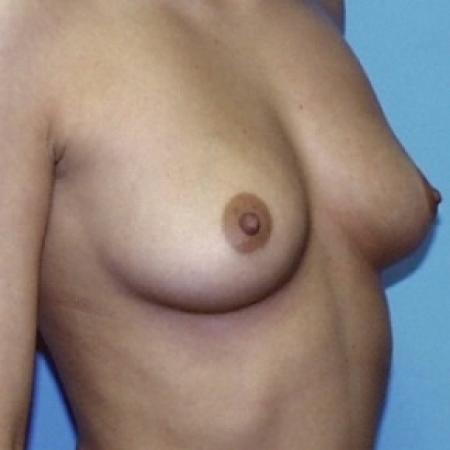 Before image 3 Case #79081 - Saline Breast Implants