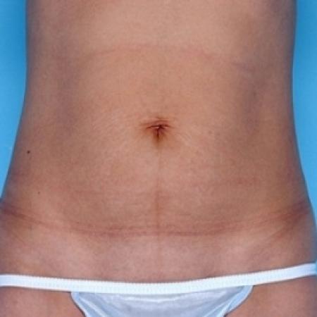Before image 1 Case #79166 - Tummy Tuck