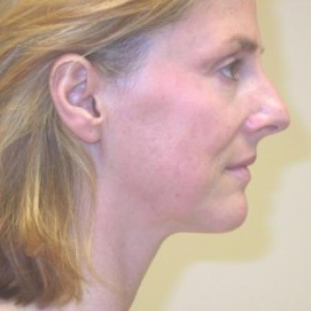 Before image 2 Case #81061 - Facelift and Rhinoplasty