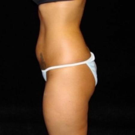Before image 3 Case #80481 - Buttocks Augmentation Via Fat Grafting with Lipsuction of Abdomen, Waist, Flanks, and Outer Thighs